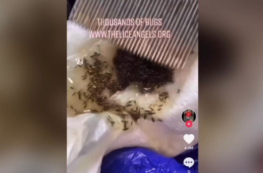 Head Lice Expert Reveals Their ‘Worst Lice Case Ever’ In Viral Video