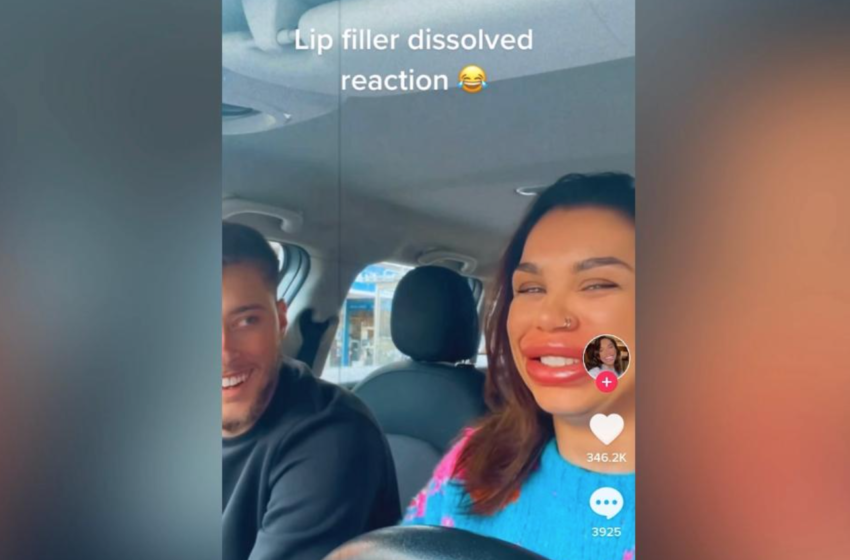  Woman Reveals Swollen Dissolved Lip Filler Process To Her Boyfriend In Viral Video