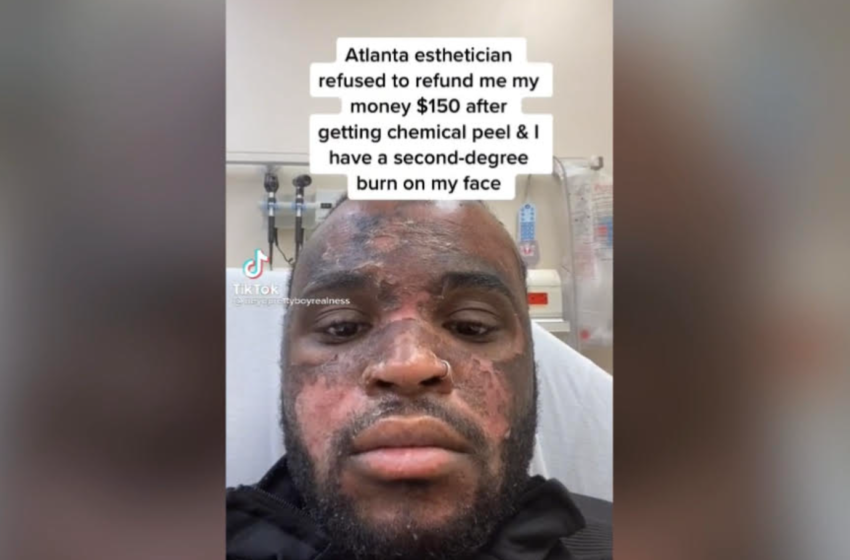  Man Says He Got Second-Degree Burns From Chemical Peel, Esthetician Said He Didn’t ‘Trust The Process’