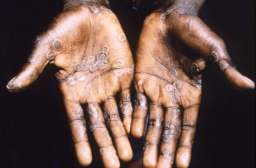  CDC Advises Sexually Active Patients with Monkeypox To Keep Their Clothes On, According To Reports