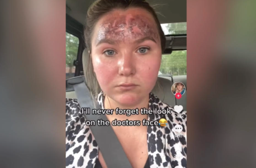  Woman Says Her Forehead Burned After Using Expired Sunscreen, Shows Aftermath In Viral Video 