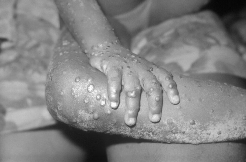  New York Governor Hochul Declares State Emergency Disaster Over The Rapid Spread Of Monkeypox